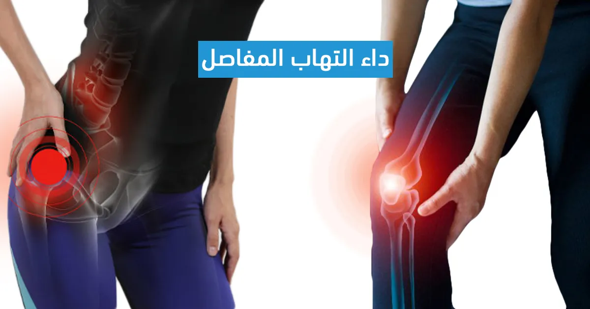 داء إلتهاب المفاصل