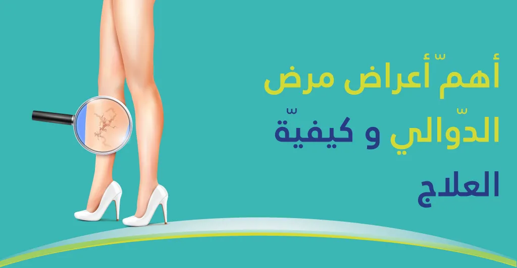 أهمّ أعراض مرض الدّوالي وكيفيّة العلاج