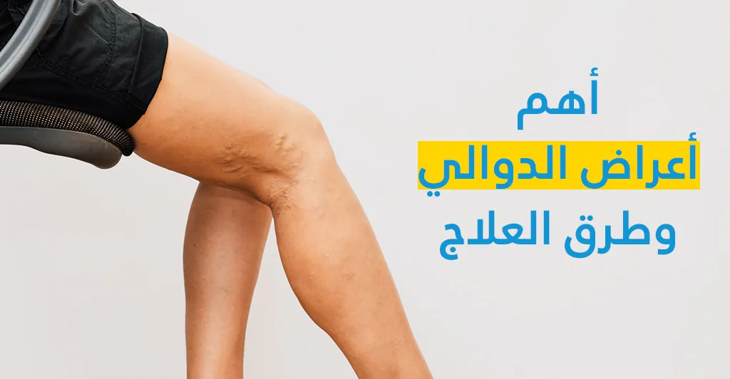 أهمّ أعراض الدّوالي وطرق العلاج