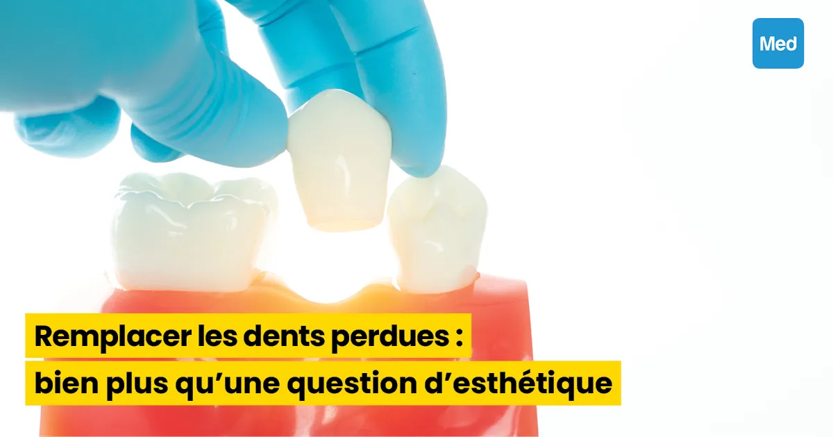 Remplacer les dents perdues : bien plus qu'une question d'esthétique