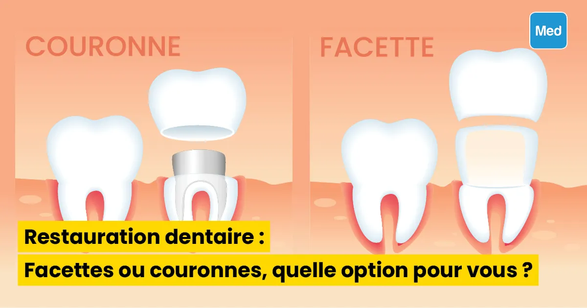 Restauration dentaire : Facettes ou couronnes, quelle option pour vous ?