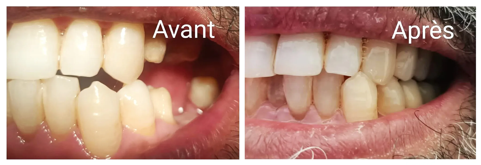 Remplacer les dents perdues : bien plus qu'une question d'esthétique
