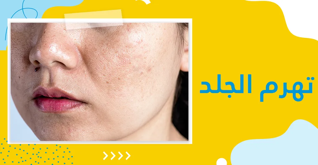 التصبغات الجلدية :أصنافها و أسبابها و طرق العلاج