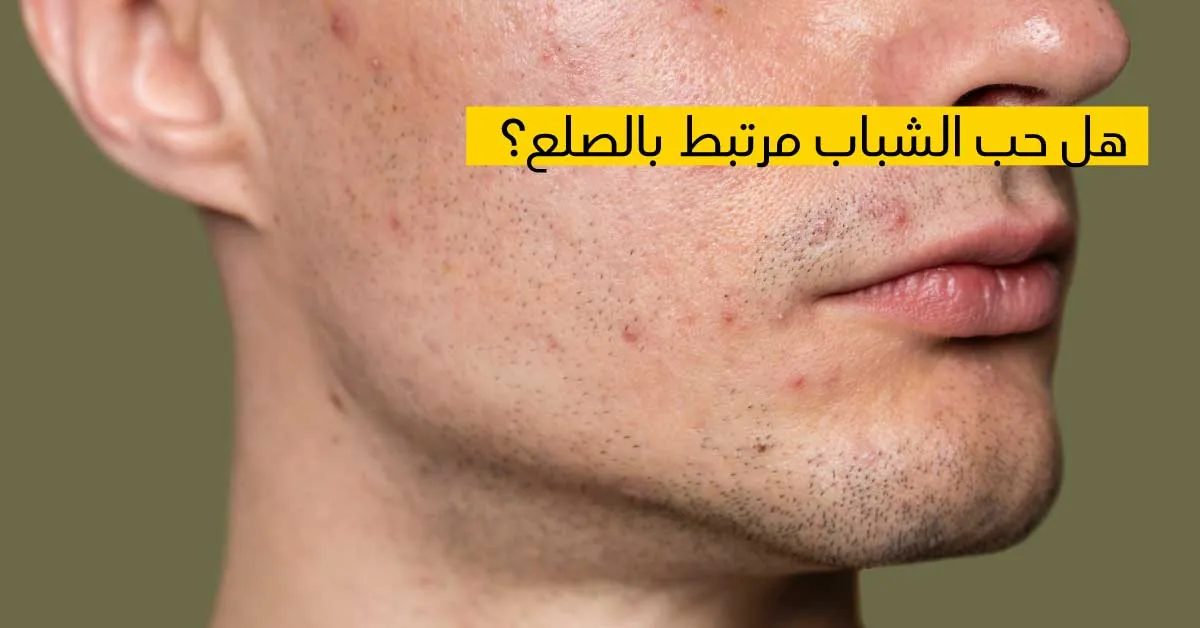 هل حب الشباب مرتبط بالصلع ؟