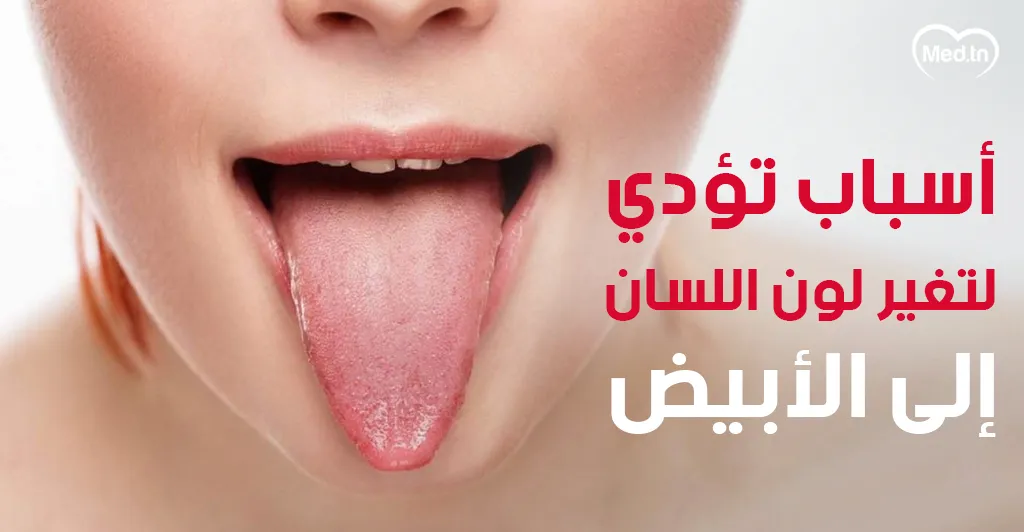 أسباب تؤدي لتغير لون اللسان إلى الأبيض