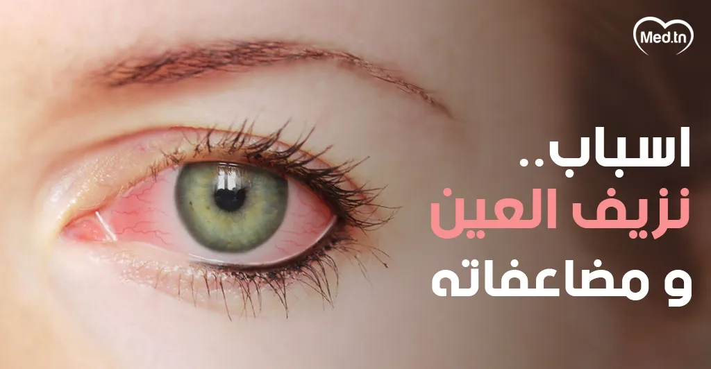 اسباب نزيف العين .. و مضاعفاته