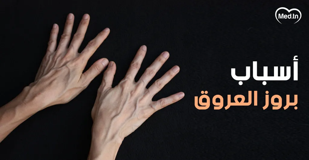 أسباب بروز العروق