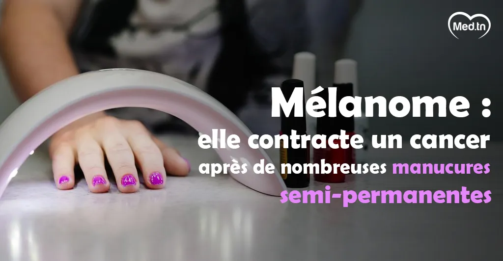 Mélanome : elle contracte un cancer après de nombreuses manucures semi-permanentes