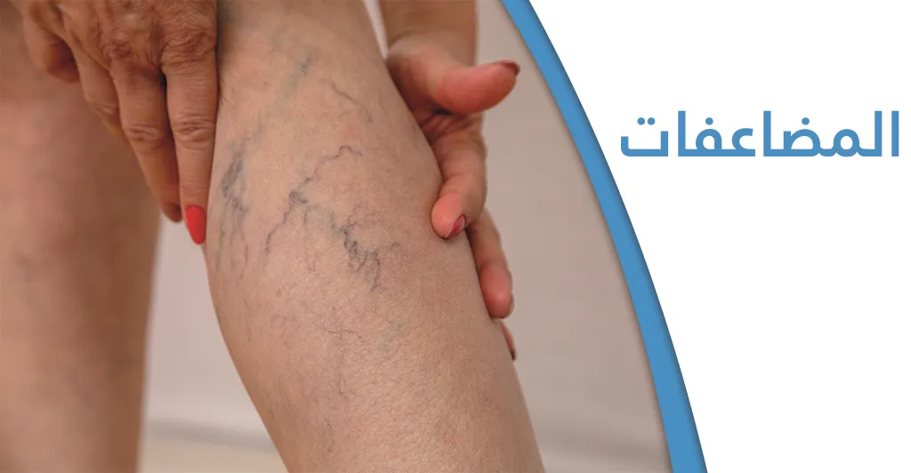 أهمّ أعراض الدّوالي وطرق العلاج