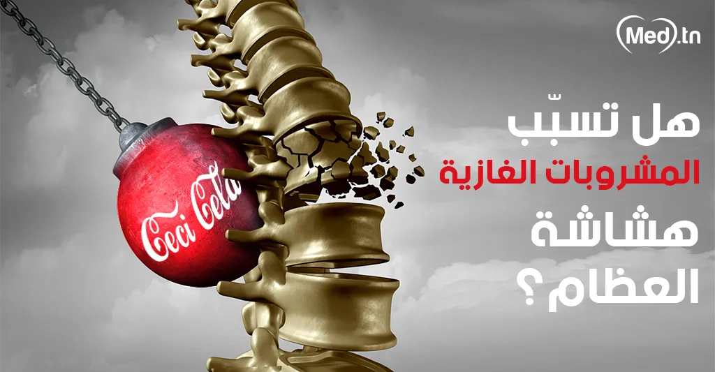 هل تسبّب المشروبات الغازية هشاشة العظام؟