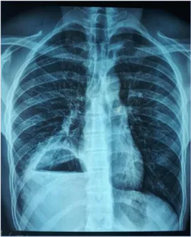 Diaphragmatic Hydatid Cyst, A Rare Entity Simulating A Thoracic