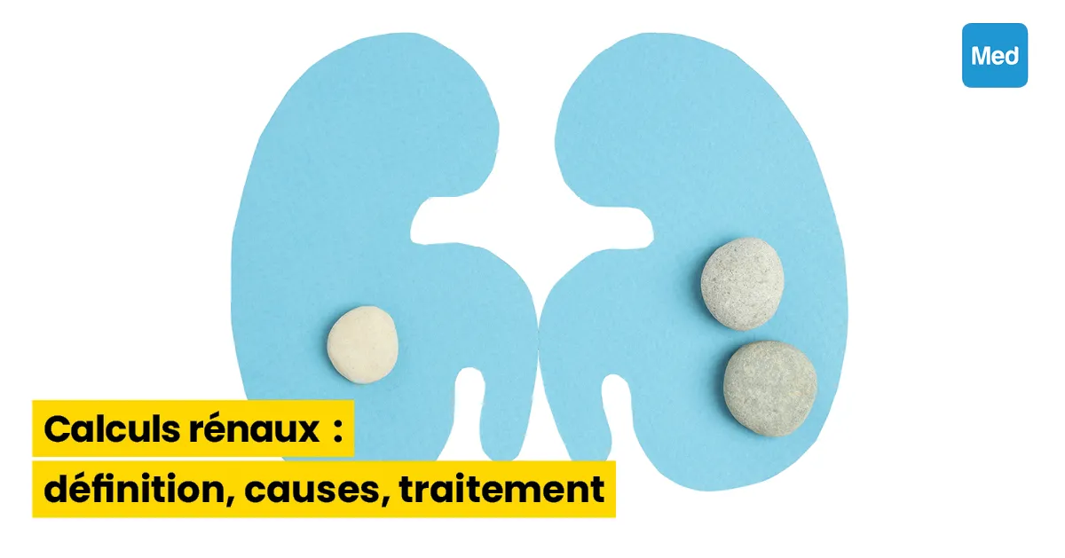 Calculs rénaux : définition, causes, traitement