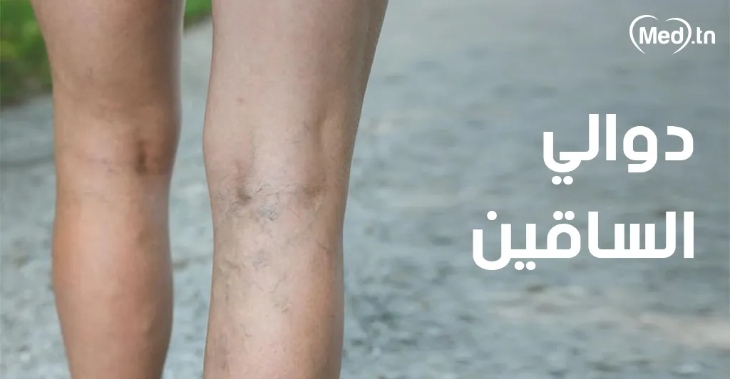 دوالي الساقين