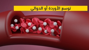  توسع الأوردة أو الدوالي  