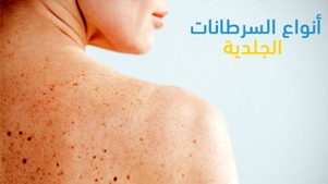 أنواع السرطانات الجلدية