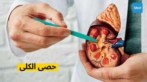 حصى الكلى: الأسباب والأعراض والعلاج