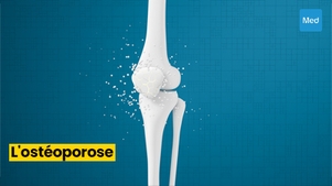 Comprendre et Prévenir l'Ostéoporose : Des Os Solides pour une Vie Saine