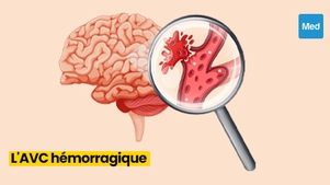 Comprendre l'AVC Hémorragique : Causes, Symptômes et Prise en Charge