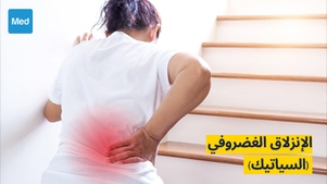 الإنزلاق الغضروفي (السياتيك): الأسباب والأعراض والتشخيص والعلاج
