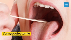 Comprendre l'amygdalectomie: Quand et pourquoi cette intervention est-elle nécessaire ?