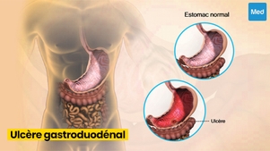 L'ulcère gastroduodénal : une maladie fréquente et traitable