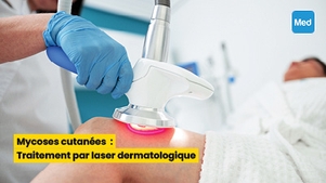 Mycoses cutanées : Traitement par laser dermatologique