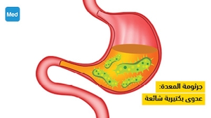 جرثومة المعدة: عدوى بكتيرية شائعة