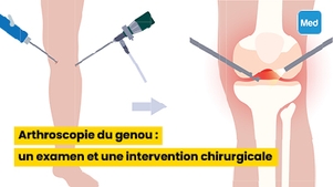 Arthroscopie du genou : un examen et une intervention chirurgicale