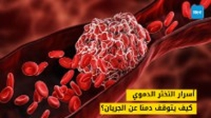 أسرار التخثر الدموي: كيف يتوقف دمنا عن الجريان