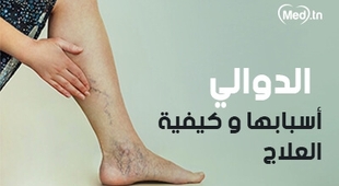 Magazine الدوالي أسبابها و كيفية العلاج