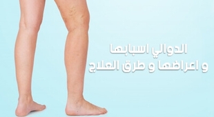 Makaleler الدوالي : اسبابها و اعراضها و طرق العلاج