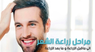 المجلة الطبية مراحل زراعة الشعر