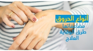 Magazine أنواع الحروق و مضاعفاتها و طرق الوقاية و العلاج