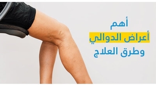 Magazine أهمّ أعراض الدّوالي وطرق العلاج