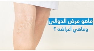 Magazine ماهو مرض الدّوالي وماهي أعراضه ؟