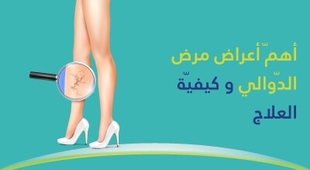 Makaleler أهمّ أعراض مرض الدّوالي وكيفيّة العلاج