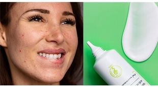 Makaleler ماهي أهمّ أسباب ظهور حبّ الشّباب وهل توجد حلول لعلاجه ؟