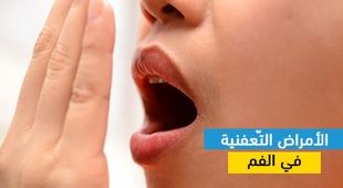 Makaleler الأمراض التّعفنية في الفم