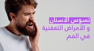 Makaleler تسوّس الأسنان و الأمراض التّعفنية في الفم