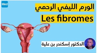 Magazine الورم الليفي الرحمي