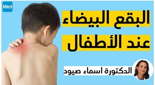 Magazine البقع البيضاء عند الأطفال