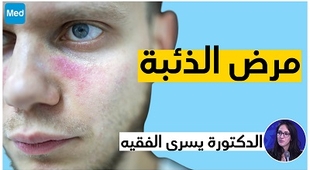 Makaleler مرض الذئبة