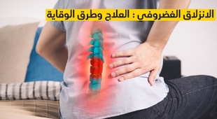 المجلة الطبية الانزلاق الغضروفي : العلاج وطرق الوقاية