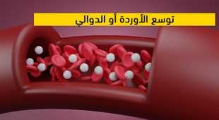 المجلة الطبية  توسع الأوردة أو الدوالي  