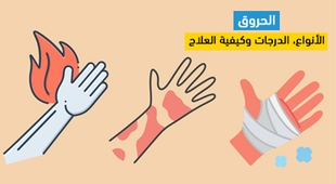 Magazine الحروق: الأنواع، الدرجات وكيفية العلاج