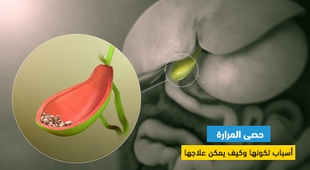 Magazine حصى المرارة : أسباب تكونها وكيف يمكن علاجها