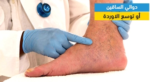 Makaleler دوالي الساقين أو توسع الدوالي