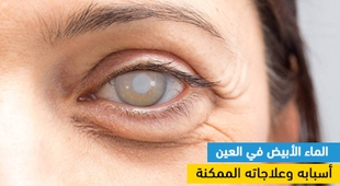 Magazine الماء الأبيض في العين : أسبابه وعلاجاته الممكنة