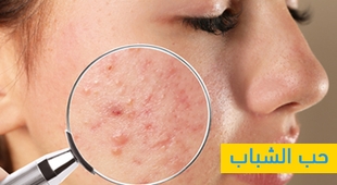 Makaleler حب الشباب