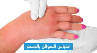 المجلة الطبية احتباس السوائل بالجسم